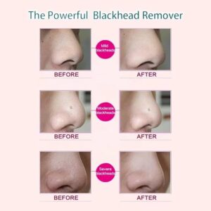 Electric Facial Blackhead Remover